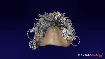 211 - Upper RPD Class II mod 2