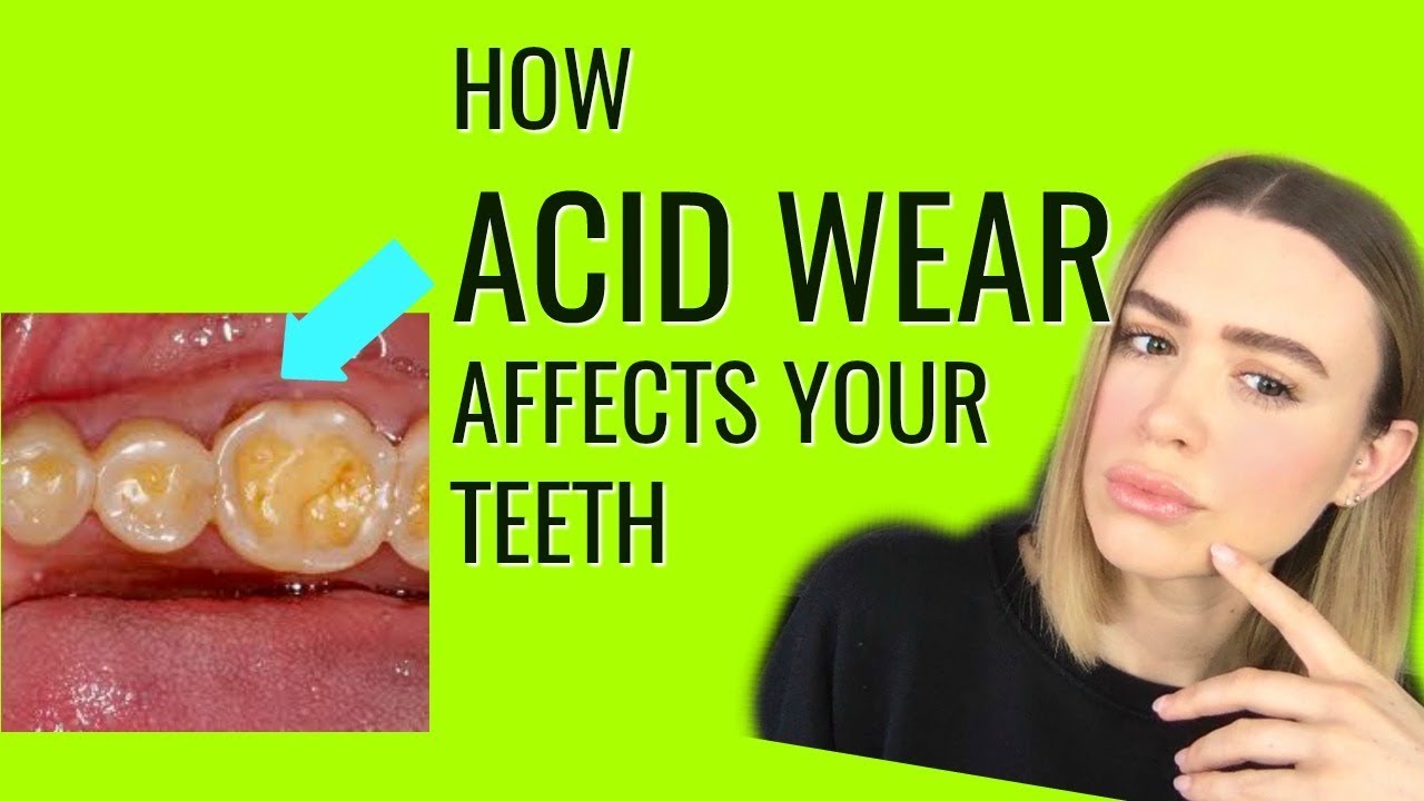 Protect Your Teeth From Acid Wear