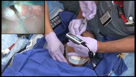 Awake intubation with King Vision using standard blade - from AoD