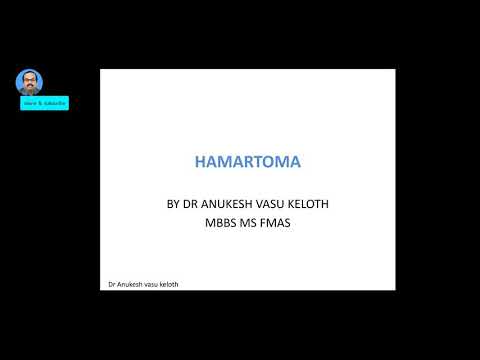 Video: Hamartoma Of The Lung: Symptoms, Treatment, Causes