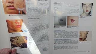 Milady Esthetics Chapter 4  Pages 139-148 Disorders Diseases of the Skin Esthetician Aesthetician