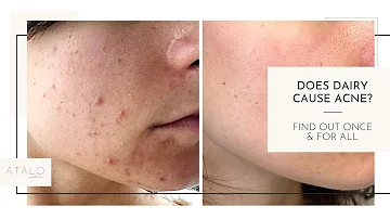 Does Cadbury cause pimples?