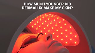 See what Dermalux Flex did for my skin | Alice Hart-Davis