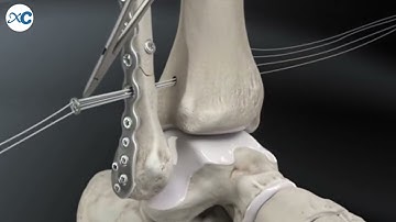 Adjustable titanium plate for distal tibia and fibula