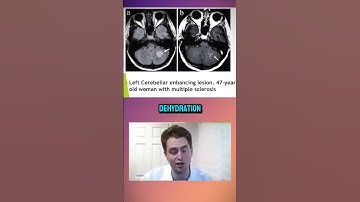 Multiple Sclerosis Lesion in the Cerebellum Causing Vertigo