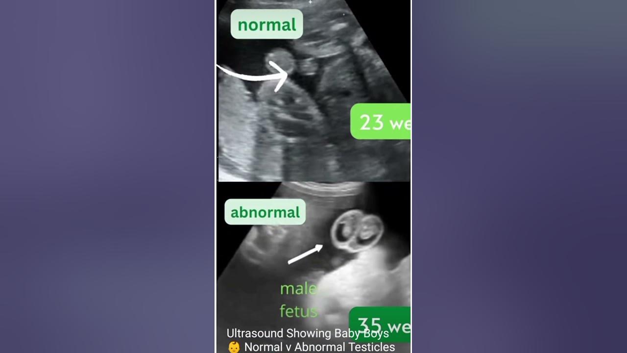 Normal baby testicle vs abnormal baby testicles youtube