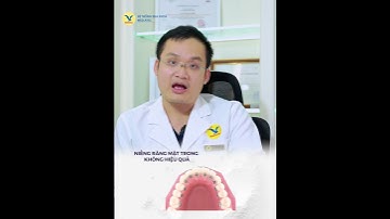 Nên niềng răng mặt trong hay mặt ngoài?