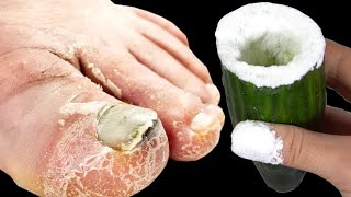 Cure toenail fungus in less than 1 minute! You have to do it! 3 US dollars. 60 years old recipe