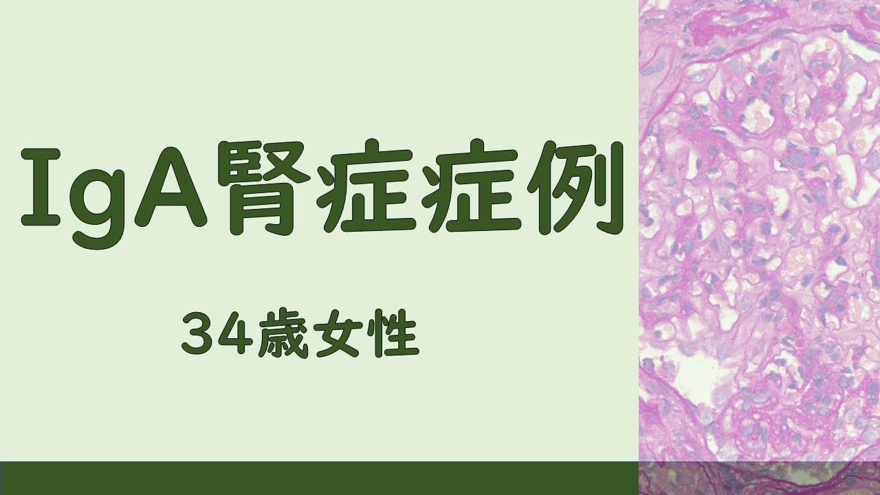 IgA腎症症例 34歳女性(慢性変化重度・増殖性変化なし) YouTube