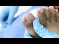 Ep_791 Ingrown toenail removal 👣 หนูว่าเล็บพี่เป็นเชื่อรา 😱 (This clip from Thailand)