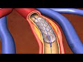 Animation - Coronary stent placement