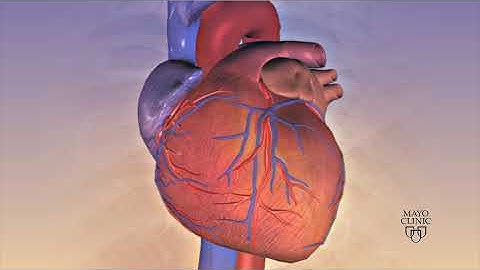 Animation - Coronary stent placement