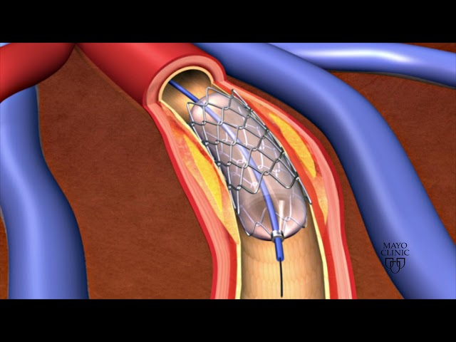 Animation - Coronary stent placement class=