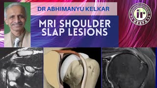 DR ABHIMANYU KELKAR | SLAP LESIONS | MRI SHOULDER