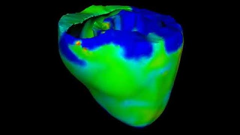 Fibrillation with Electrical and Mechanical Activity in the Canine Ventricles