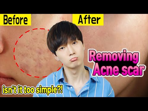 Korean tips for Removing Acne Scar !