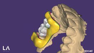 Multifuncional Guide Design in Exocad