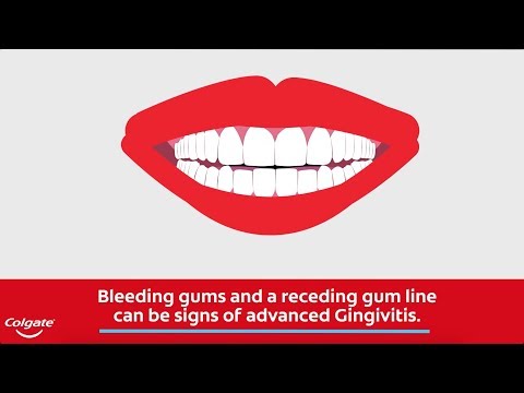 Bleeding Gums and the Signs of Gingivitis | Colgate®