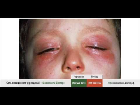 Аллергия на холод Аллергия на холод