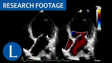 Dilated left ventricle with global hypokinesia. Libman-Sacks endocarditis: 1 of 4