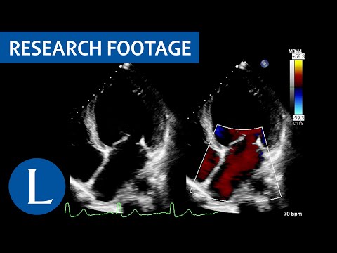 Video: Hypokinesia: Keadaan, Gejala Dan Banyak Lagi Yang Berkaitan