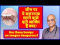 Bumps On Back Of Tongue ज भ पर ल ल द न ह न Hindi Dr Rajive Bhatia Bumps On Back Of Tongue ज भ पर ल ल द न ह न Hindi Dr Rajive Bhatia