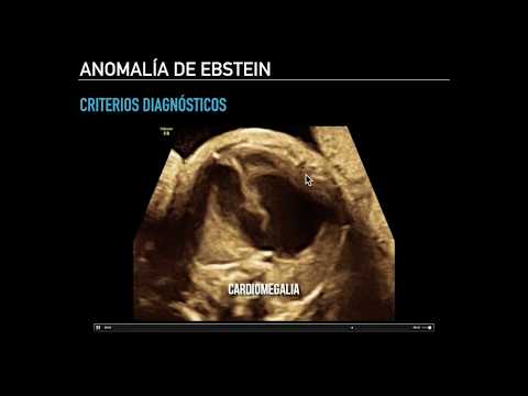 Vídeo: Anomalía De Ebstein: Síntomas, Tratamiento, Formas, Etapas, Diagnóstico