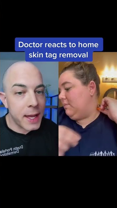 dr scholls skin tag removal review｜TikTok Search