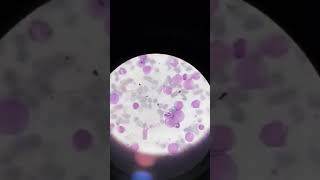 Chronic myeloid leukemia