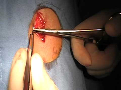 Lipoma operacija