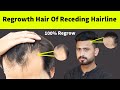 It's Truth ! Regrowth Receding Hair line Hair Naturally | How To Regrowth Hair Line Naturally