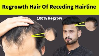It's Truth ! Regrowth Receding Hair line Hair Naturally | How To Regrowth Hair Line Naturally