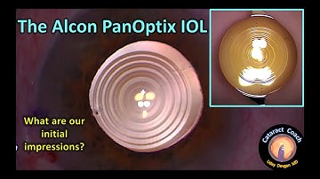 Review of the Alcon PanOptix lens for Cataract Surgery