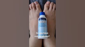 How to remove foot corns and calluses
