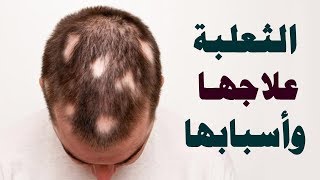 ما هي أعراض مرض الثعلبة ؟ وما أسبابها ؟ وما علاجها ؟