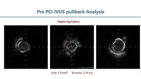 Orbital Atherectomy in Calcium
