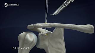 Innovative Solution for Acromioclavicular Joint Dislocation and Clavicle Fracture Surgery Animation