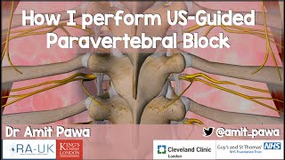 How I Perform US-Guided Paravertebral Blocks