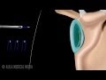 Bankart Lesion and Repair Surgery Animation