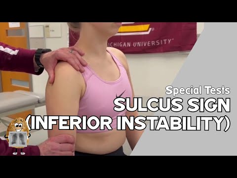 Inferior Sulcus Sign