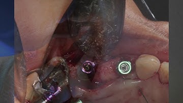 #12 and #14 guided implant surgery with simultaneous GBR