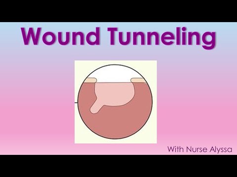 Video: Jednostavni načini liječenja tunelskih rana: 11 koraka (sa slikama)
