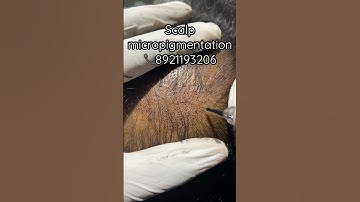 Scalp micropigmentation (SMP) treatment for hair density at MALA, Thrissur, kerala 📞8921193206