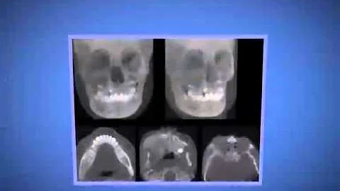 O que causa a displasia ectodérmica?
