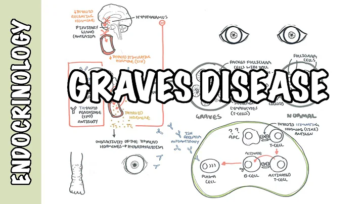 Graves Disease - Overview (causes, pathophysiology, investigations and treatment) - DayDayNews
