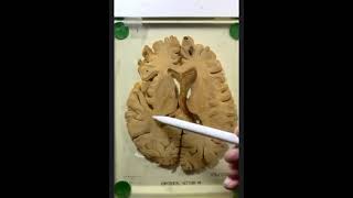 Sectional Anatomy of the Brain   Cross Sections