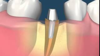 Оперативные вмешательства (Обучающее видео для стоматологов)