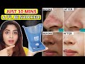 सिर्फ 10MIN में यूँ STEAM से चेहरा साफ़ करे-कील BLACKHEADS,कालापन SPOTS हो जायेंगे दूर-GET CLEAR SKIN