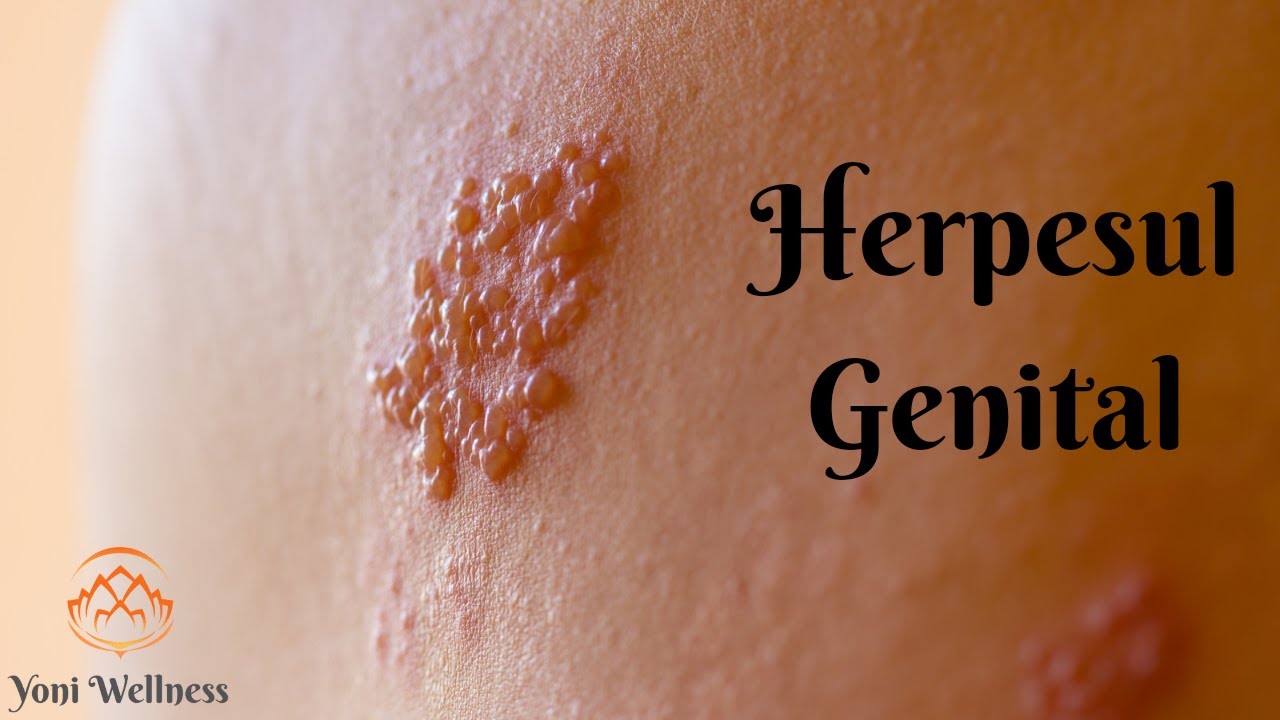 S2. Ep 33 - Herpesul Genital | Boli cu transmitere sexuală | Cum se manifestă ? Cum se tratează ?