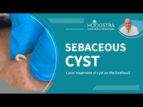 Sebaceous cyst on the forehead – Laser treatment – 25097 Sebaceous cyst on the forehead – Laser treatment – 25097